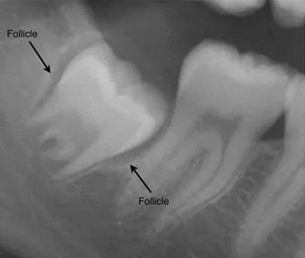 young wisdom tooth patient